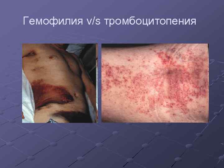 Гемофилия v/s тромбоцитопения 