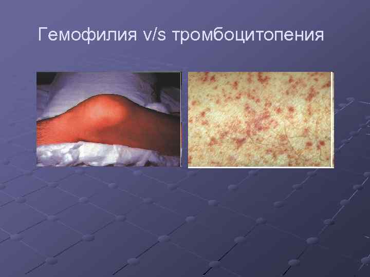 Гемофилия v/s тромбоцитопения 