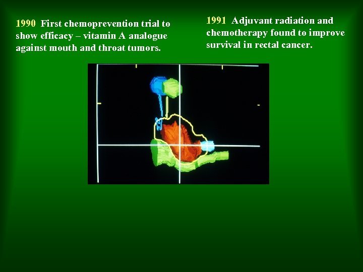 1990 First chemoprevention trial to show efficacy – vitamin A analogue against mouth and