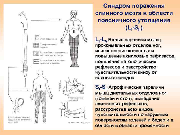 Синдром поражения