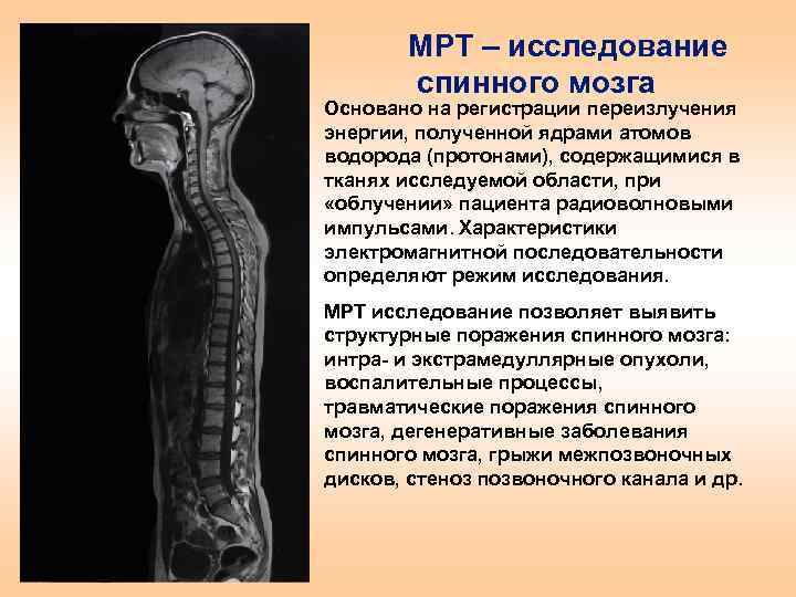 Поражение спинного мозга. Мрт спинного мозга. Клинические методы исследования спинного мозга. Поражение спинного мозга мрт. Рентгенологическое исследование спинного мозга.