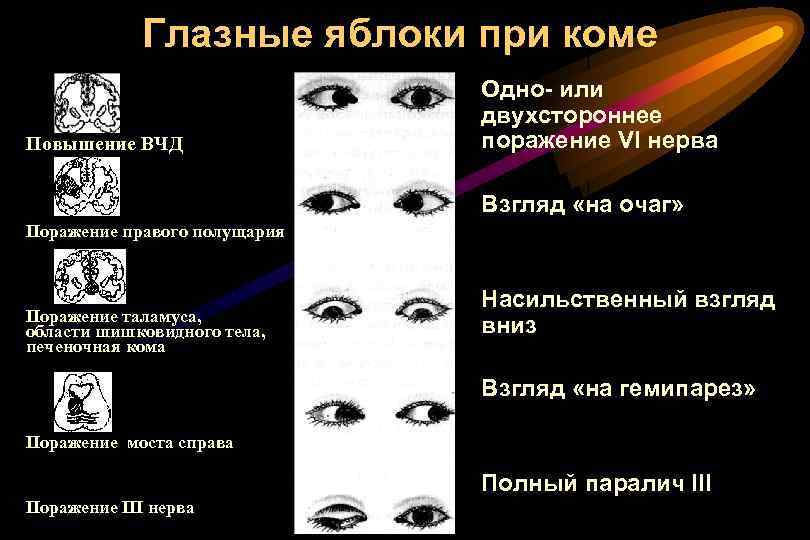 Глазные яблоки при коме Повышение ВЧД Одно- или двухстороннее поражение VI нерва Взгляд «на