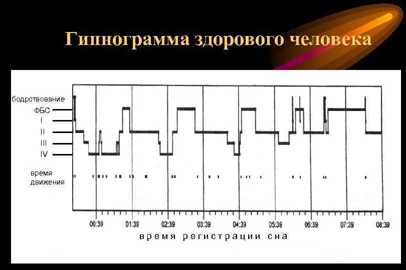 Гипнограмма здорового человека бодрствование ФБС I II IV время движения время регистрации сна 