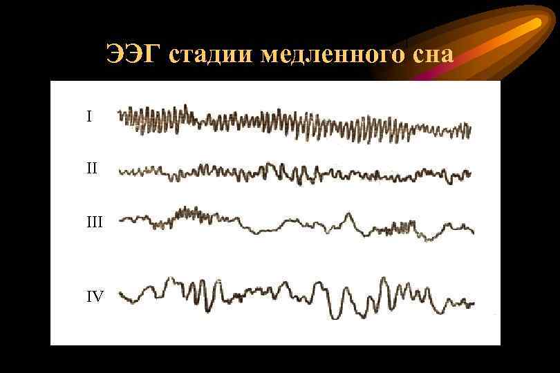 ЭЭГ стадии медленного сна I II IV 