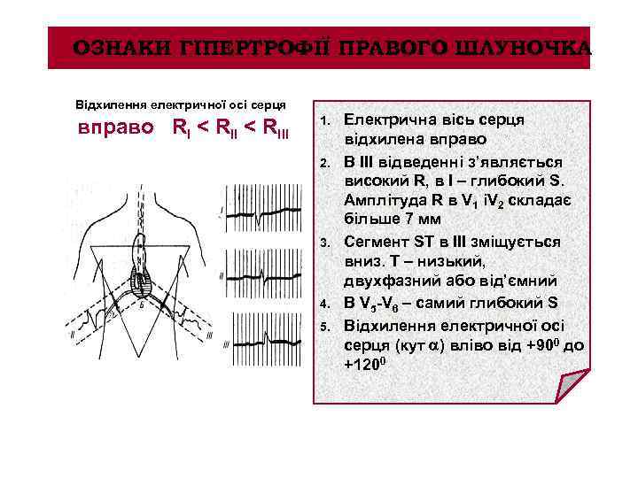 ОЗНАКИ ГІПЕРТРОФІЇ ПРАВОГО ШЛУНОЧКА Відхилення електричної осі серця вправо RI < RIII 1. 2.