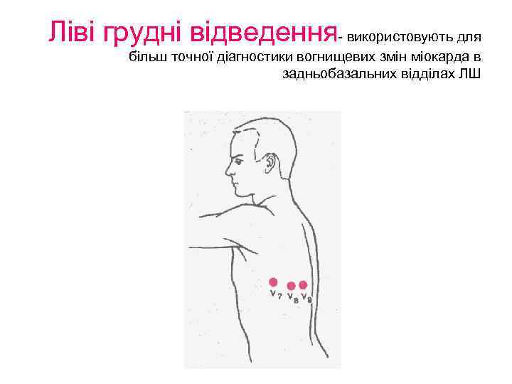 Ліві грудні відведення- використовують для більш точної діагностики вогнищевих змін міокарда в задньобазальних відділах