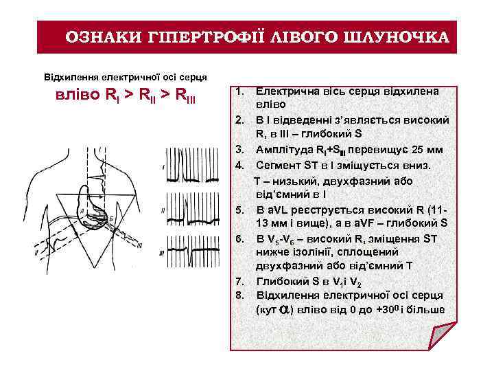 ОЗНАКИ ГІПЕРТРОФІЇ ЛІВОГО ШЛУНОЧКА Відхилення електричної осі серця вліво RI > RIII 1. Електрична