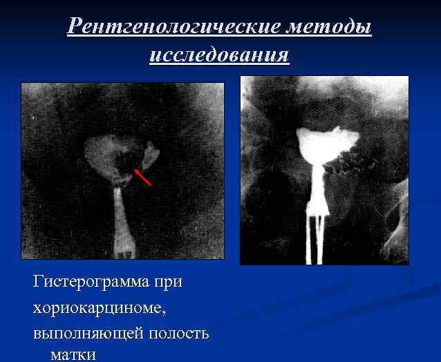 Рентгенологические методы исследования Гистерограмма при хориокарциноме, выполняющей полость матки 