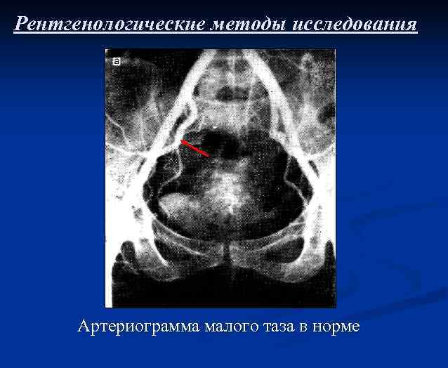 Рентгенологические методы исследования Артериограмма малого таза в норме 