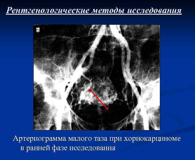 Рентгенологические методы исследования Артериограмма малого таза при хориокарциноме в ранней фазе исследования 