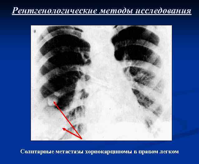 Рентгенологические методы исследования Солитарные метастазы хориокарциномы в правом легком 