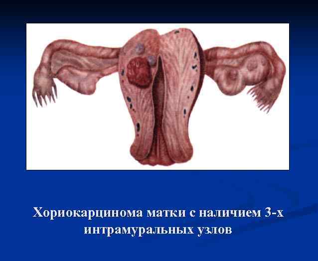 Хориокарцинома матки с наличием 3 -х интрамуральных узлов 