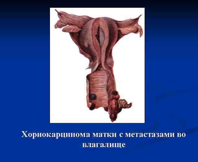 Хориокарцинома матки с метастазами во влагалище 