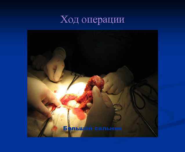 Ход операции Большой сальник 