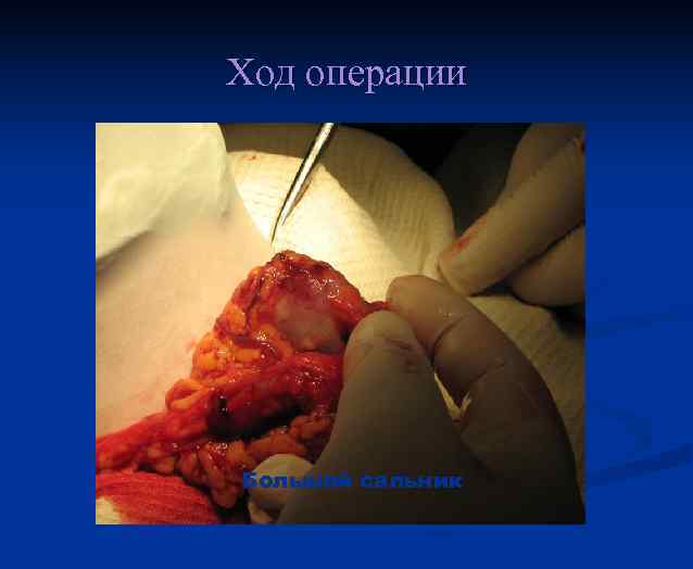 Ход операции Большой сальник 