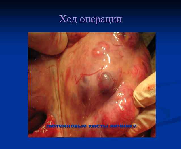 Ход операции лютеиновые кисты яичника 