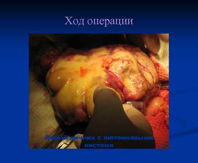 Ход операции Левый яичник с лютеиновыми кистами 