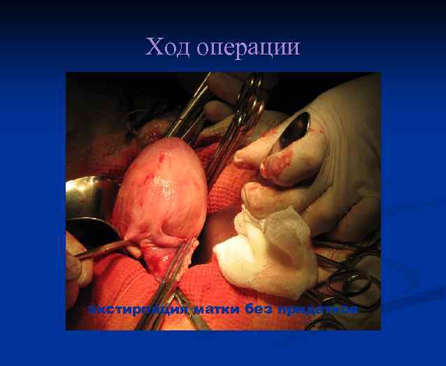 Ход операции экстирпация матки без придатков 
