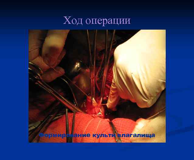 Ход операции Формирование культи влагалища 