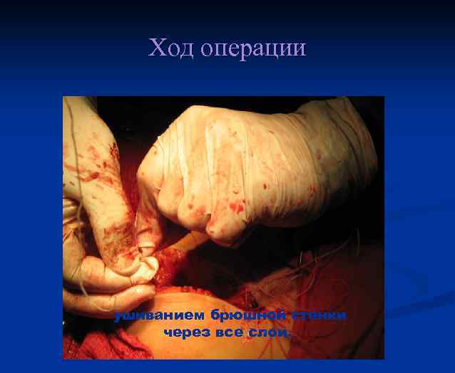 Ход операции ушиванием брюшной стенки через все слои. 