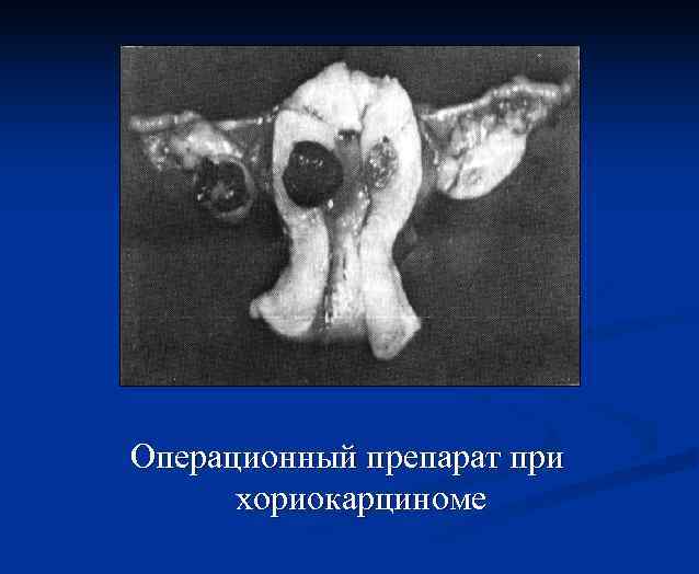 Операционный препарат при хориокарциноме 