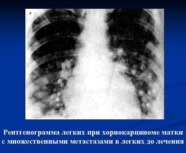 Рентгенограмма легких при хориокарциноме матки с множественными метастазами в легких до лечения 