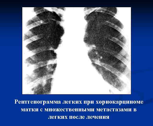 Рентгенограмма легких при хориокарциноме матки с множественными метастазами в легких после лечения 