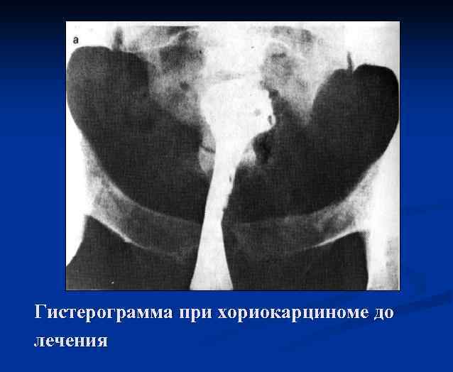 Гистерограмма при хориокарциноме до лечения 