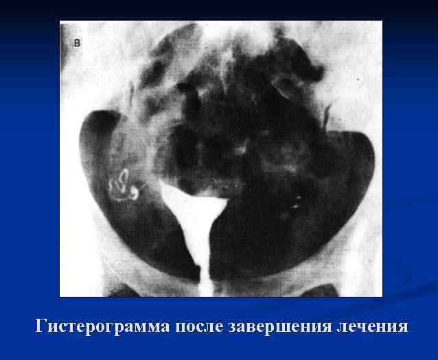 Гистерограмма после завершения лечения 