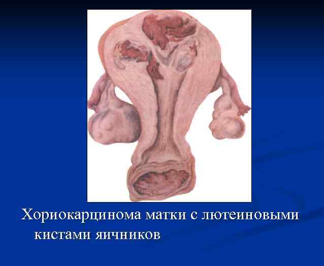 Хориокарцинома матки с лютеиновыми кистами яичников 