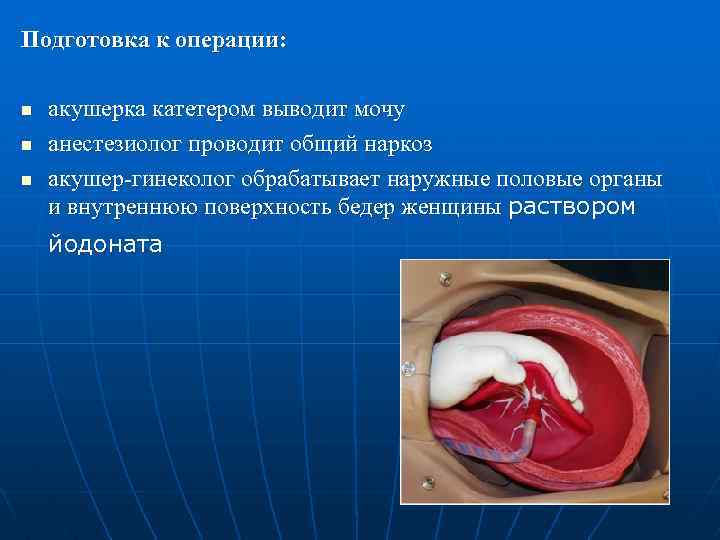 Подготовка к операции: n n n акушерка катетером выводит мочу анестезиолог проводит общий наркоз