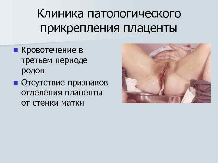 Клиника патологического прикрепления плаценты Кровотечение в третьем периоде родов n Отсутствие признаков отделения плаценты