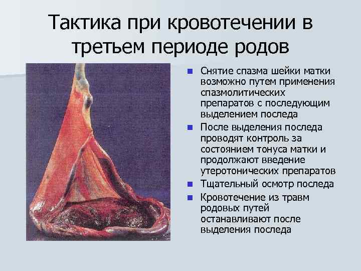 Тактика при кровотечении в третьем периоде родов n n Снятие спазма шейки матки возможно