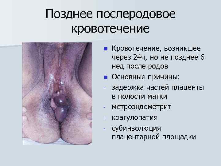 Позднее послеродовое кровотечение n n - Кровотечение, возникшее через 24 ч, но не позднее