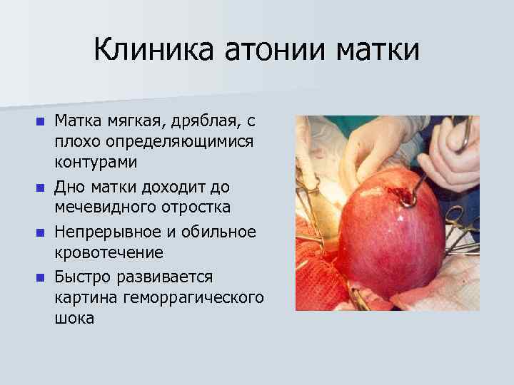 Клиника атонии матки Матка мягкая, дряблая, с плохо определяющимися контурами n Дно матки доходит