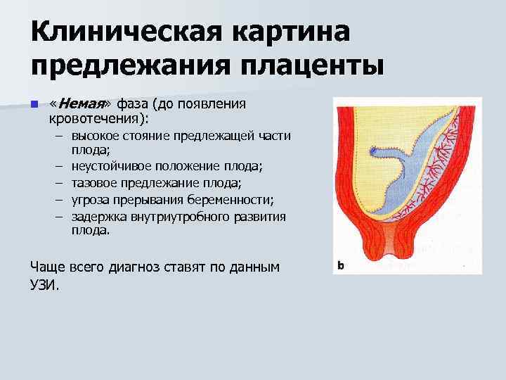 Клиническая картина предлежания плаценты n «Немая» фаза (до появления кровотечения): – высокое стояние предлежащей