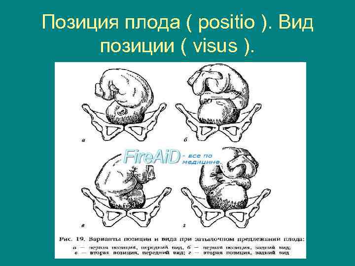 Позиция плода ( positio ). Вид позиции ( visus ). 