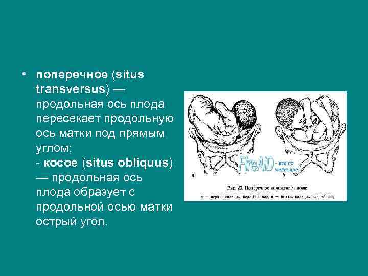  • поперечное (situs transversus) — продольная ось плода пересекает продольную ось матки под