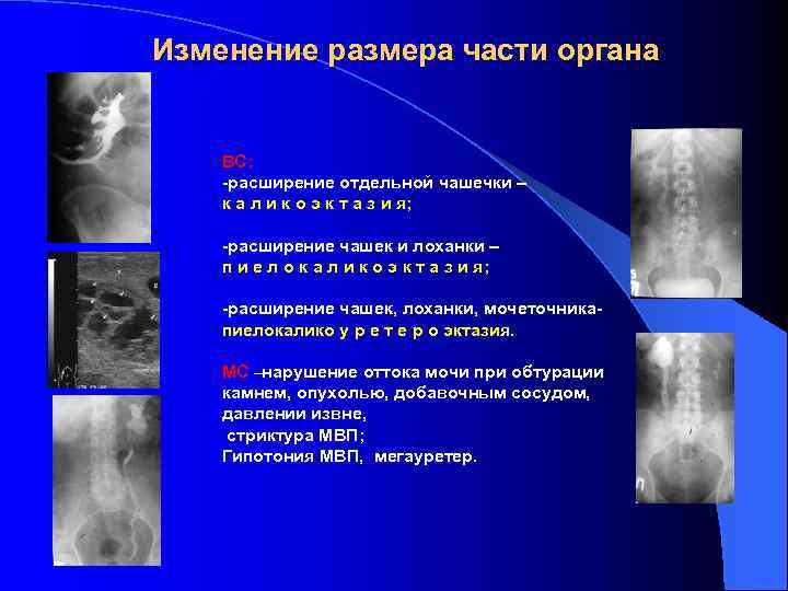 Изменение размера части органа ВС: -расширение отдельной чашечки – к а л и к