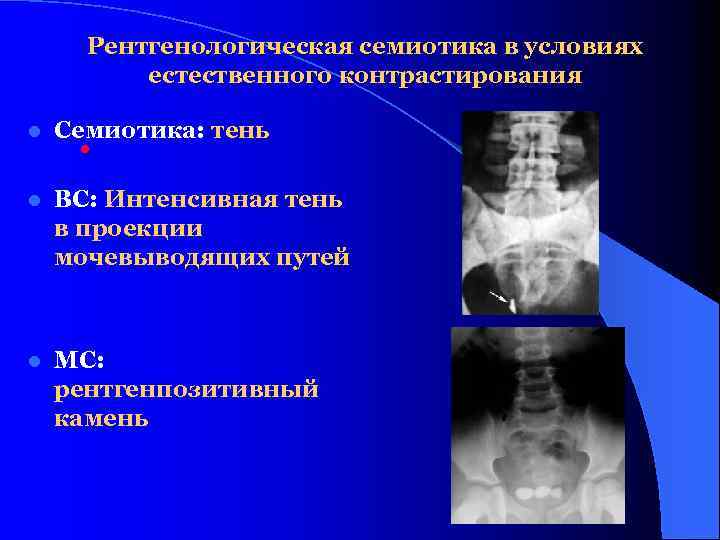 Рентгенологическая семиотика в условиях естественного контрастирования l Семиотика: тень • l ВС: Интенсивная тень