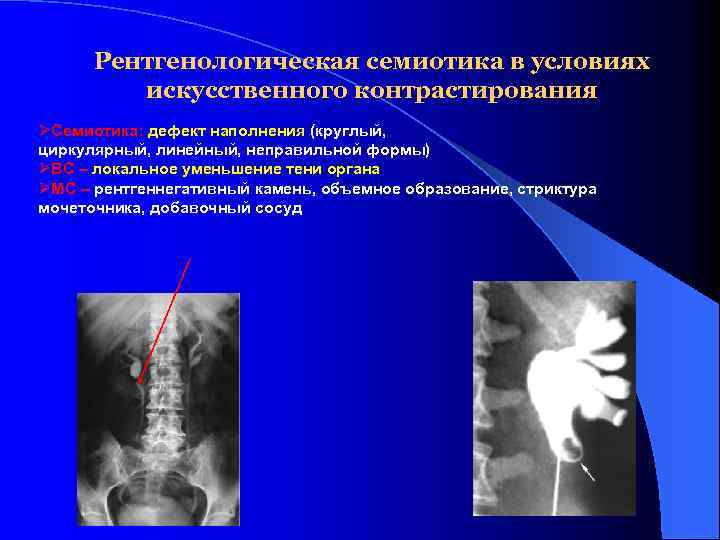 Рентгенологическая семиотика в условиях искусственного контрастирования ØСемиотика: дефект наполнения (круглый, циркулярный, линейный, неправильной формы)