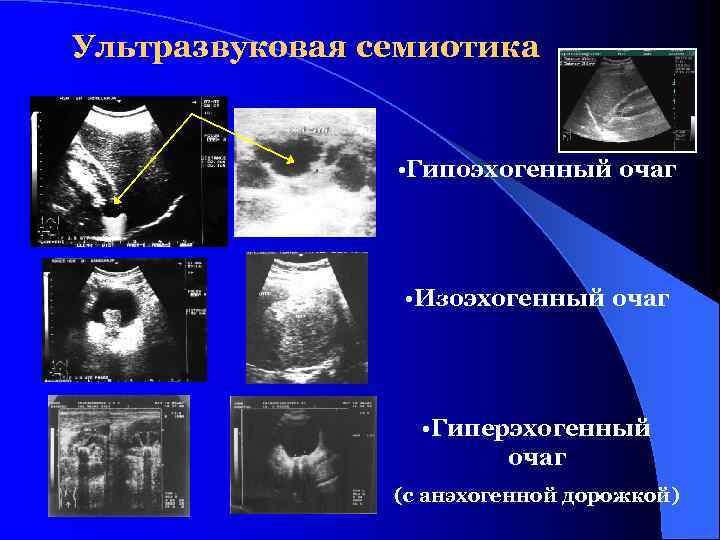 Ультразвуковая семиотика • Гипоэхогенный очаг • Изоэхогенный очаг • Гиперэхогенный очаг (с анэхогенной дорожкой)