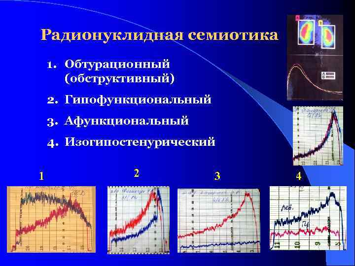 Радионуклидная семиотика 1. Обтурационный (обструктивный) 2. Гипофункциональный 3. Афункциональный 4. Изогипостенурический 1 2 3