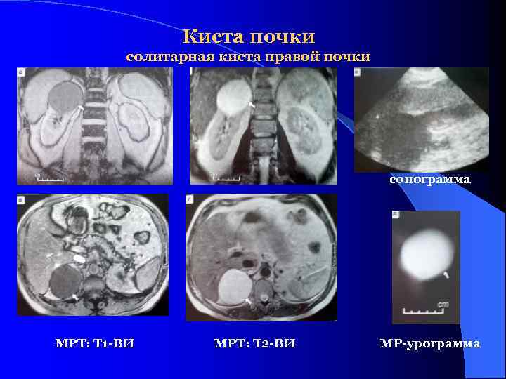 Киста почки солитарная киста правой почки сонограмма МРТ: Т 1 -ВИ МРТ: Т 2