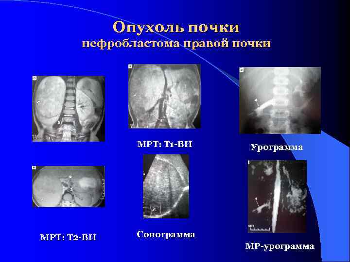 Опухоль почки нефробластома правой почки МРТ: Т 1 -ВИ МРТ: Т 2 -ВИ Урограмма