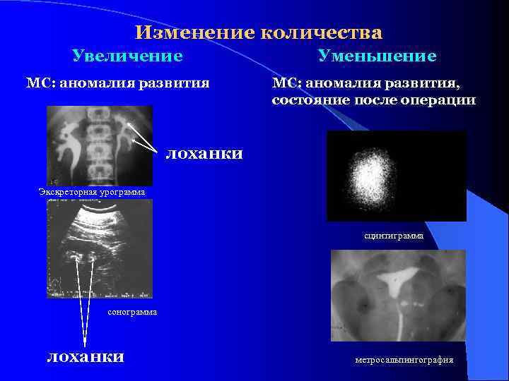 Изменение количества Увеличение МС: аномалия развития Уменьшение МС: аномалия развития, состояние после операции лоханки