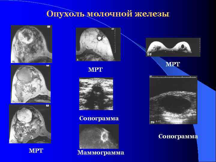 Опухоль молочной железы МРТ Сонограмма МРТ Маммограмма 