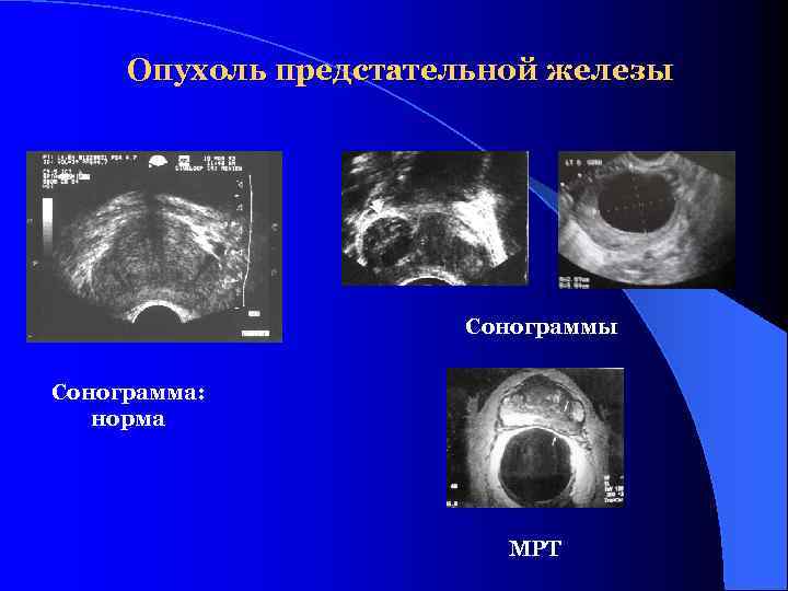 Опухоль предстательной железы Сонограмма: норма МРТ 