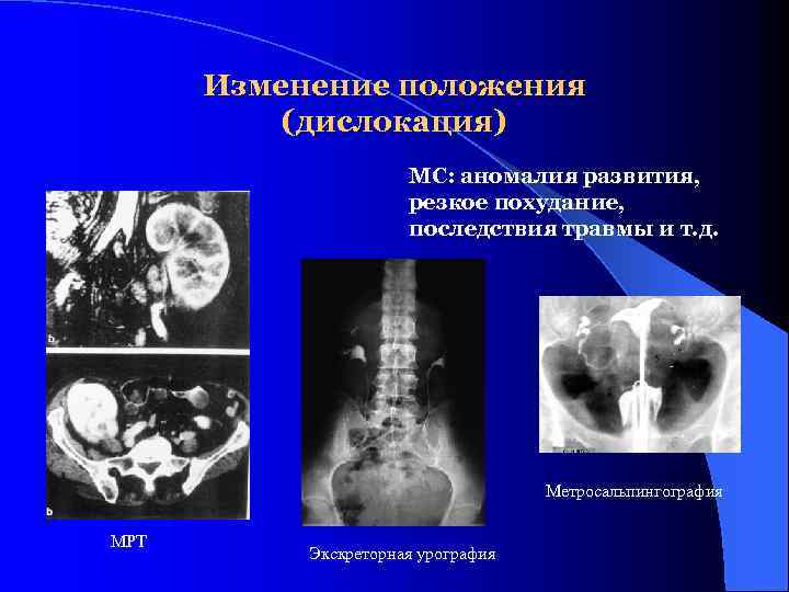 Изменение положения (дислокация) МС: аномалия развития, резкое похудание, последствия травмы и т. д. Метросальпингография