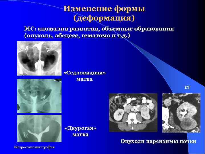 Изменение формы (деформация) МС: аномалия развития, объемные образования (опухоль, абсцесс, гематома и т. д.